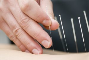 Acupuncture - Performance Rehab