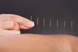 Dry Needling - Performance Rehab